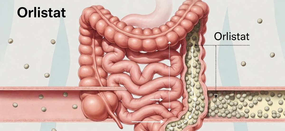 Orlistat zum Gewichtsmanagement: Was Sie vor der Anwendung wissen sollten